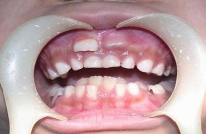 双排牙乳牙松动了还需要拔吗,一岁半宝宝长双排牙要拔吗