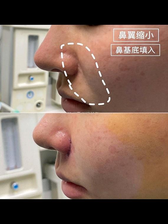 鼻基底填充好还是假体好,为什么垫鼻子要用肋骨