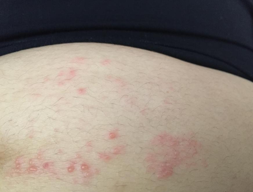 夏天皮肤痒起红点的妙招,夏季皮肤瘙痒小妙招