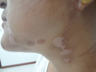 中年人患白癜风白斑明显是真的吗,如何鉴别诊断老年性白斑与白癜风