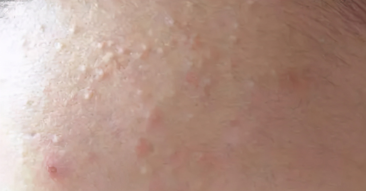 怎么才能彻底让脸上的闭口消失,如何去闭口最有效的方法