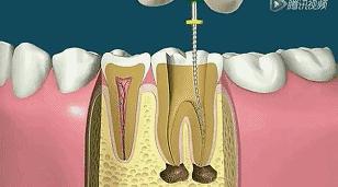 根管治疗后期症状,根管治疗全过程真的很痛吗