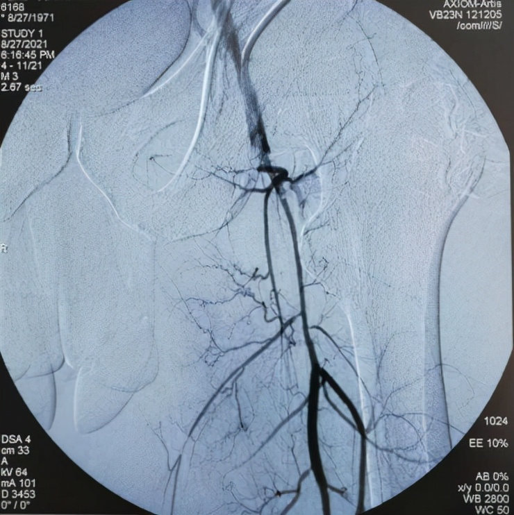 下肢动脉栓塞介入治疗后复发手术,下肢血管大面积栓塞怎么治