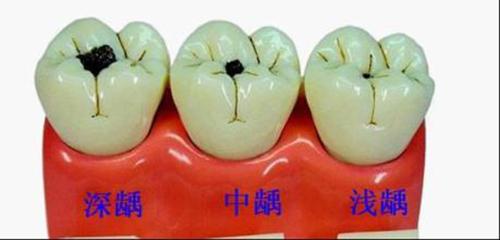 严重的蛀牙怎么修复,轻微的蛀牙修复全过程