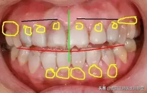 烤瓷牙十几年了有必要更换吗,烤瓷牙套里的牙烂了有什么症状