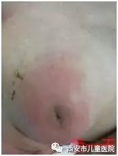 新生儿挤了乳腺就不发育了,新生儿乳腺挤早了有什么危险