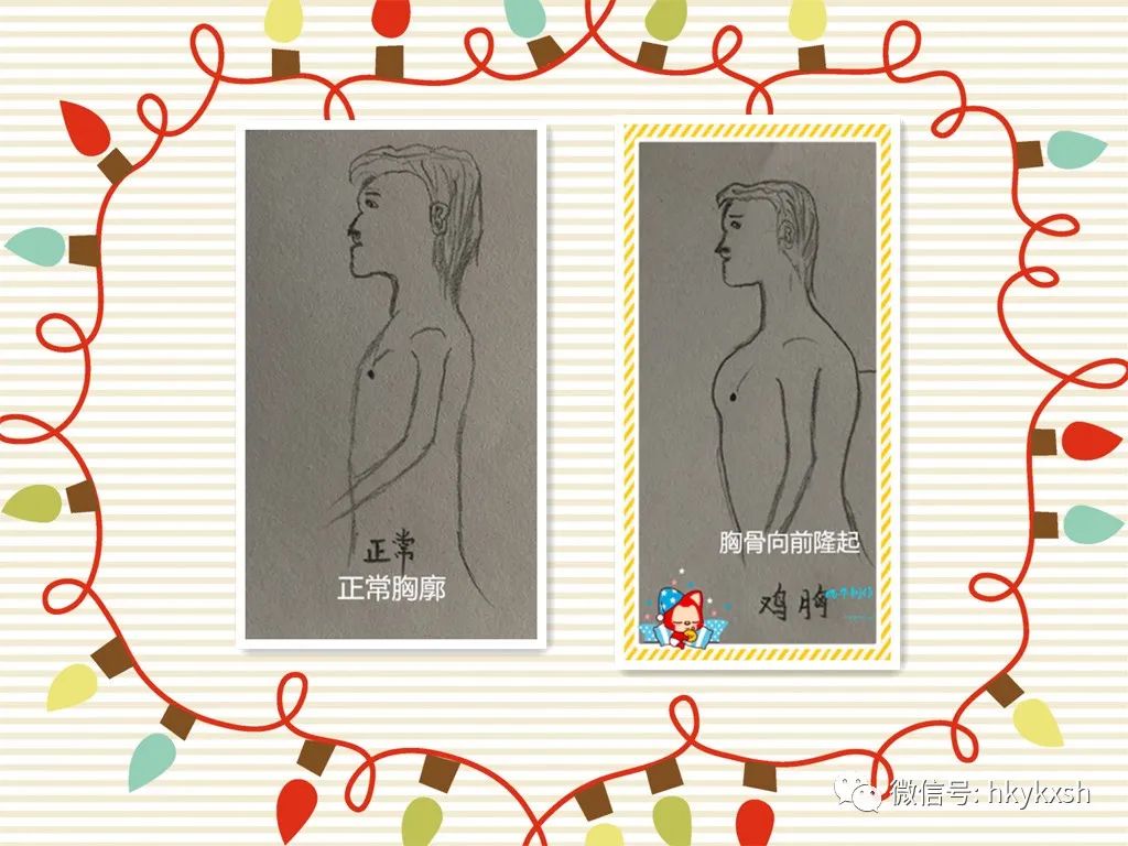 维生素d缺乏性佝偻病试题及答案,维生素d缺乏性佝偻病儿科护理学