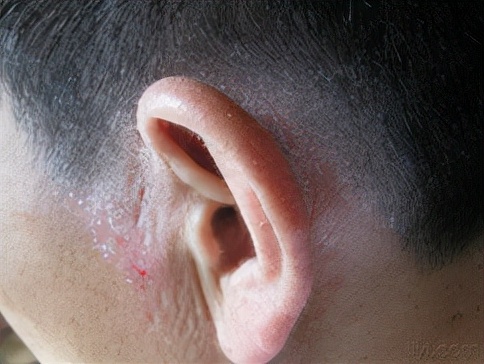 尴尬的脂溢性皮炎