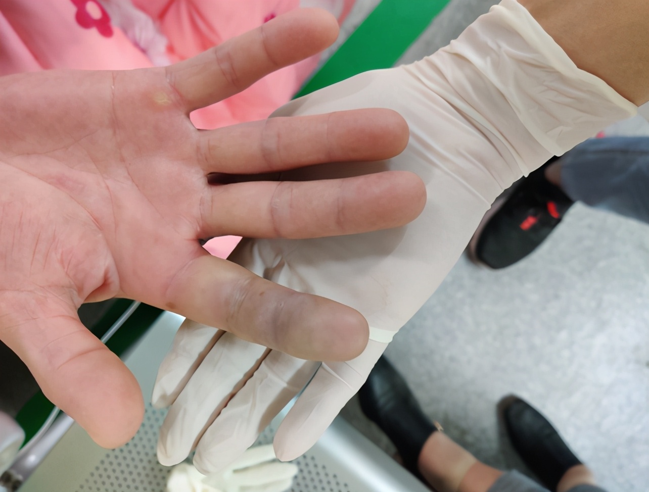 女子被福寿鱼刺戳伤手指险截肢,男子被鱼刺扎手竟需截肢才能保命