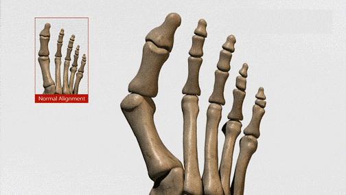 大脚骨是骨质增生吗,为什么会有大脚骨这种脚型