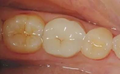牙缝越来越大是什么导致的,牙缝越来越大什么病中医怎么说