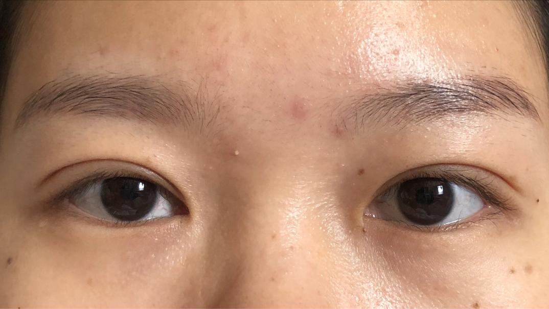 做双眼皮花了15000贵了吗,做个双眼皮手术30000块钱贵吗