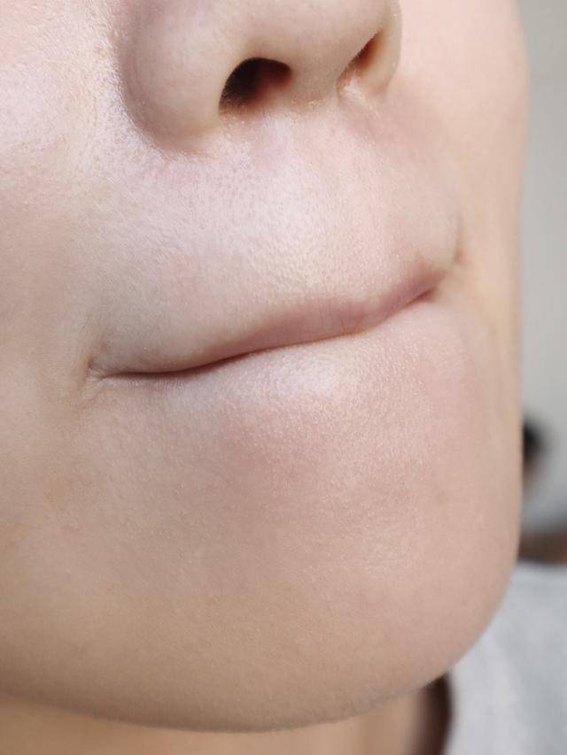 脸上有个光滑不痛不痒的小疙瘩,脸上皮肤粗糙长疙瘩是怎么回事