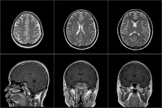 一颗智齿惹的祸,一颗智齿引发的事件