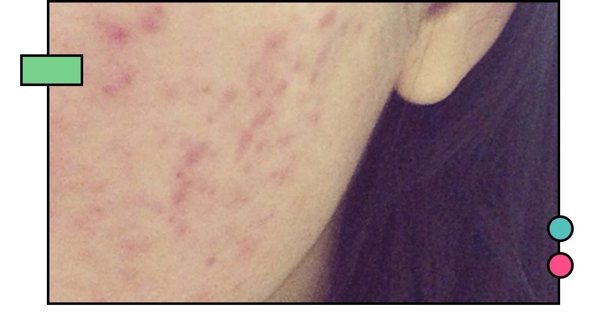 十大公认祛痘印效果最好的方法,教你几招祛痘印的最快方法