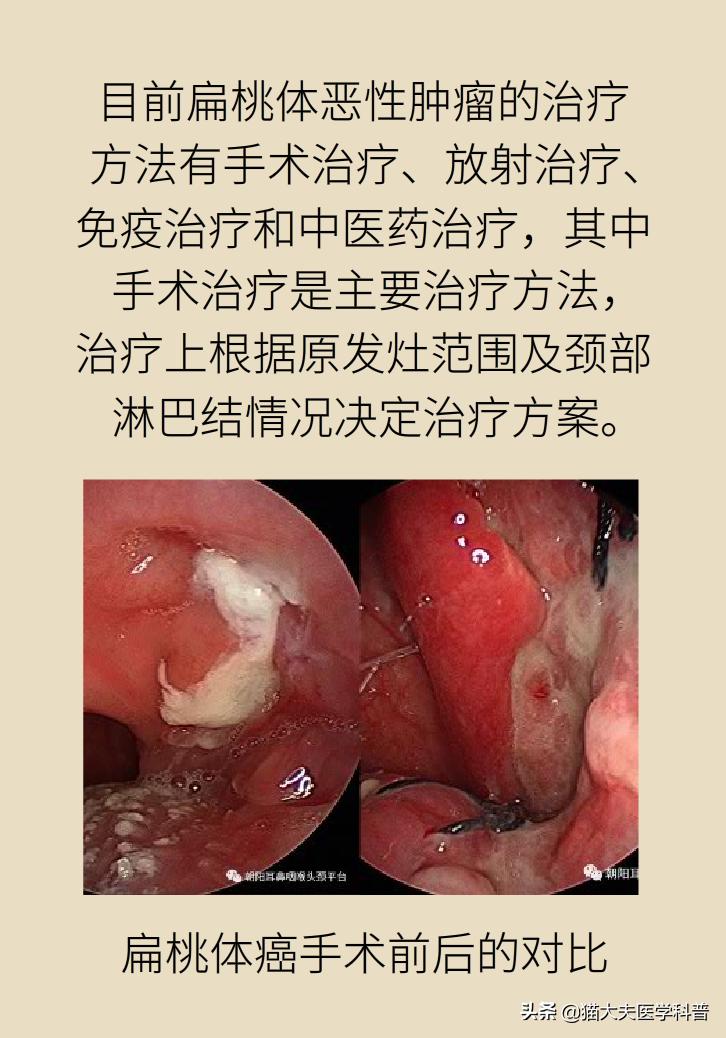 扁桃体肿大一侧和两侧区别,单侧扁桃体肿大患癌的几率是多少