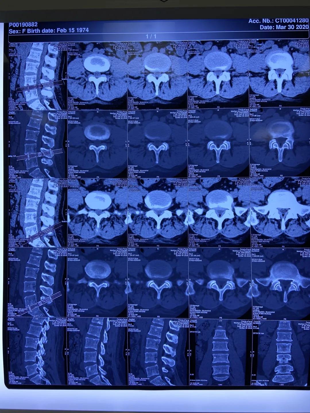 渭南治腰间盘突出哪家最好,脊柱神经外科手术