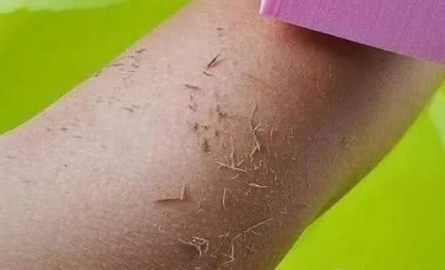 洗澡搓泥后起疙瘩,洗澡时搓出来的泥是怎么回事