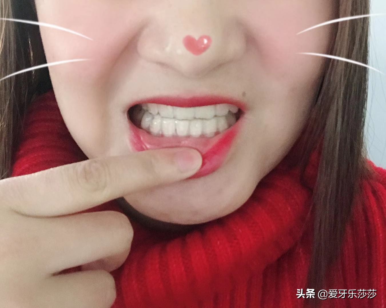 成人戴烤瓷冠能牙齿矫正吗,烤瓷冠牙齿矫正