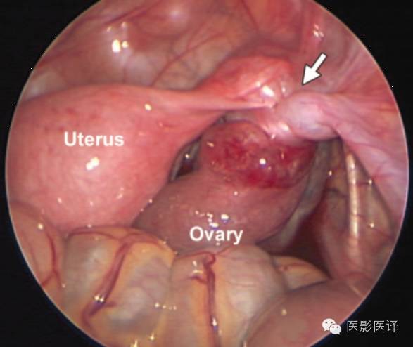 孕期发现卵巢囊肿有8cm左右,孕19周查出胎儿卵巢囊肿