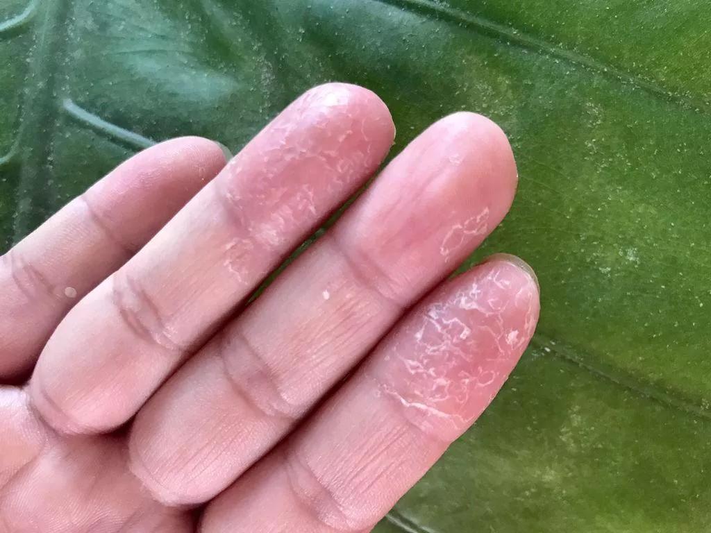 手指头脱皮是缺乏哪种维生素,脚脱皮是什么原因缺乏什么维生素