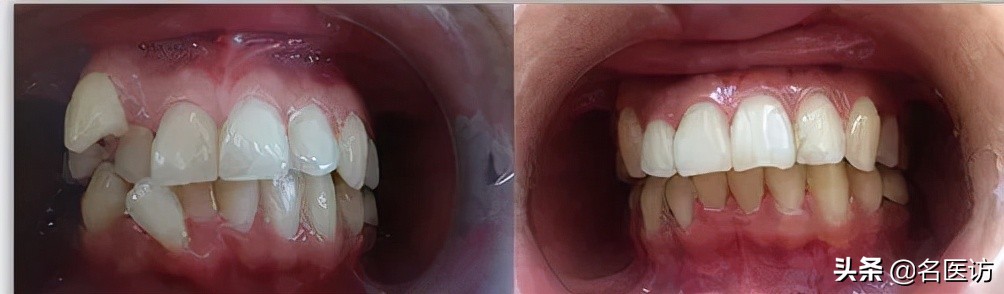 儿童牙齿矫正后要终身戴保持器吗,牙齿矫正戴保持器后还需要复诊吗