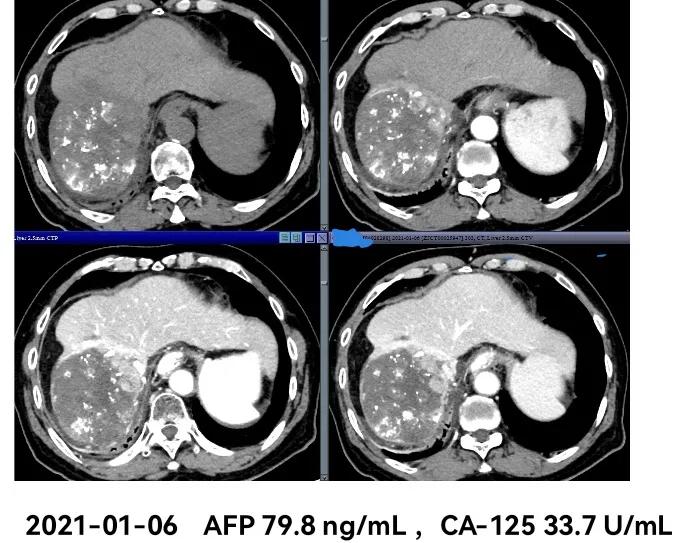 肝癌晚期靶向治疗怎么做,中国肝癌tace治疗展望
