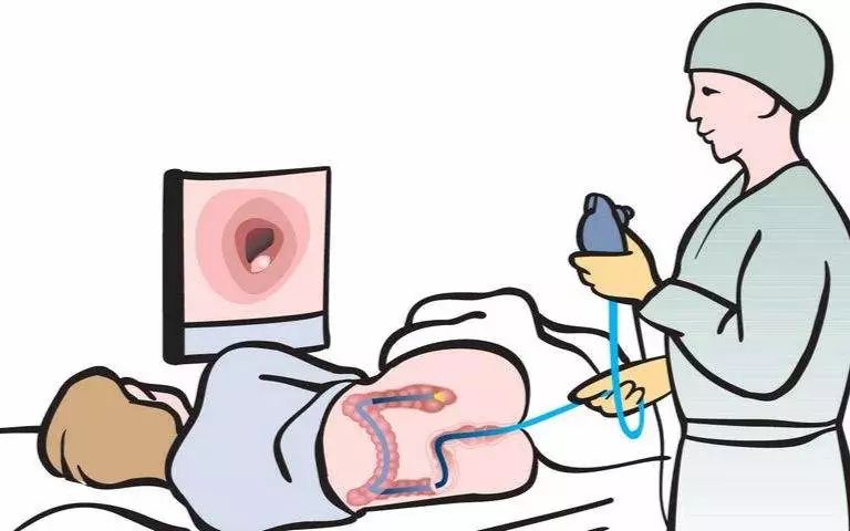 带您了解全结肠镜检查,内镜专家为您揭秘肠镜检查不可怕