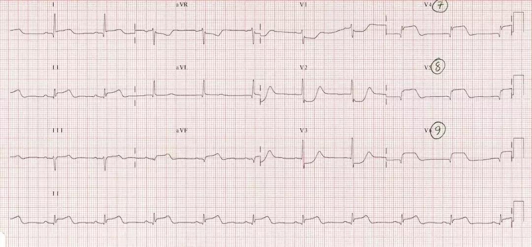 心电图和心脏彩超以哪个为准,心电图和心脏超声是一样吗