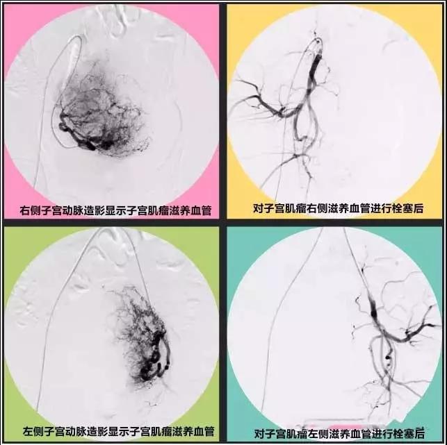 专家讲治疗子宫肌瘤的方法,微创介入子宫肌瘤栓塞术