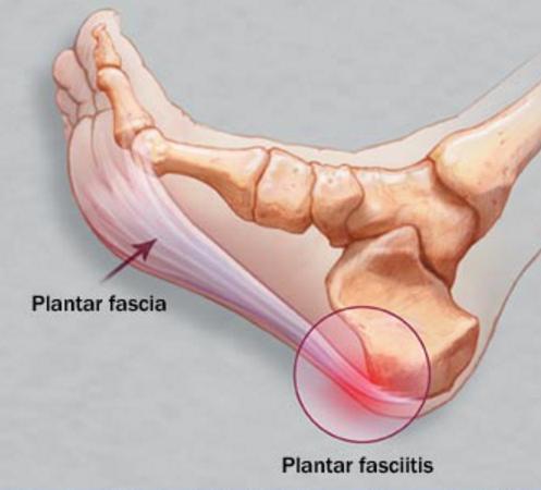 每天练习缓解足底痛图片,每天练习踮脚后腰酸胀