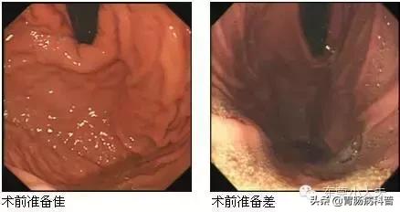 做胃镜大概几年做一次比较合适,做胃镜到底有多痛苦真实感受
