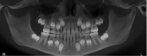 做了窝沟封闭还会蛀牙,蛀齿还需要做窝沟封闭吗