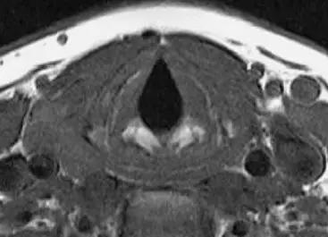 喉部病变做核磁还是ct,耳鼻喉科常见病影像诊断