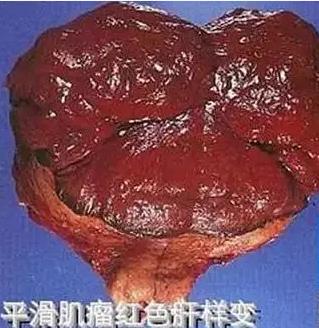 子宫肌瘤变性b超报告单会提示吗,查出子宫肌瘤囊性变怎么办