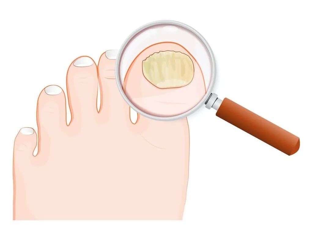 指甲发生变化，预示着哪些身体疾病？