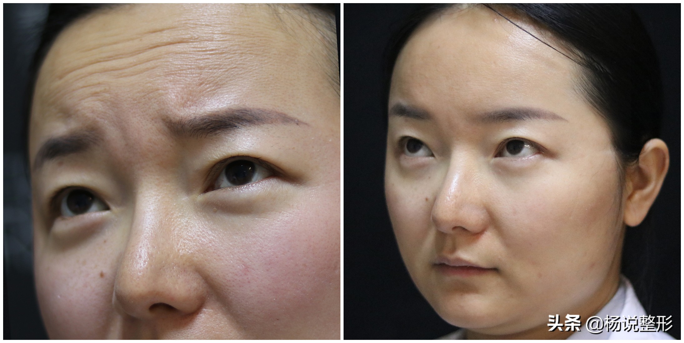 9种祛皱纹方法,除皱4招轻松应对脸部皱纹