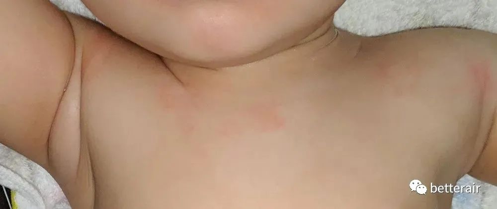 宝宝湿疹好了后一哭就变红,宝宝湿疹怕冷还是热