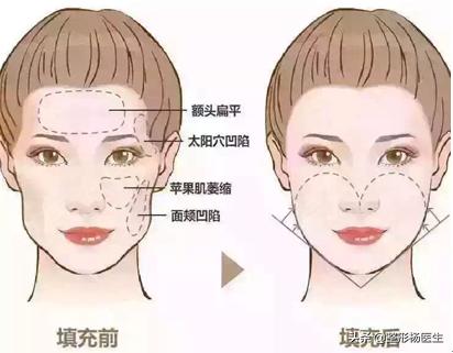 女生国字脸削骨头整容,国字脸女整形