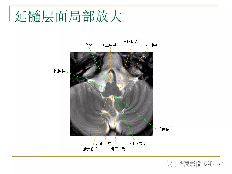 中国人脑立体定向mri应用解剖图谱,脑mri示意图
