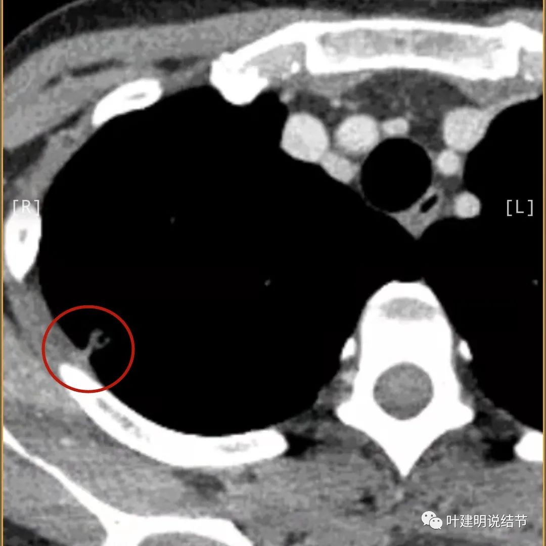 临床诊断孤立性肺结节,空洞型结节一般是什么性质