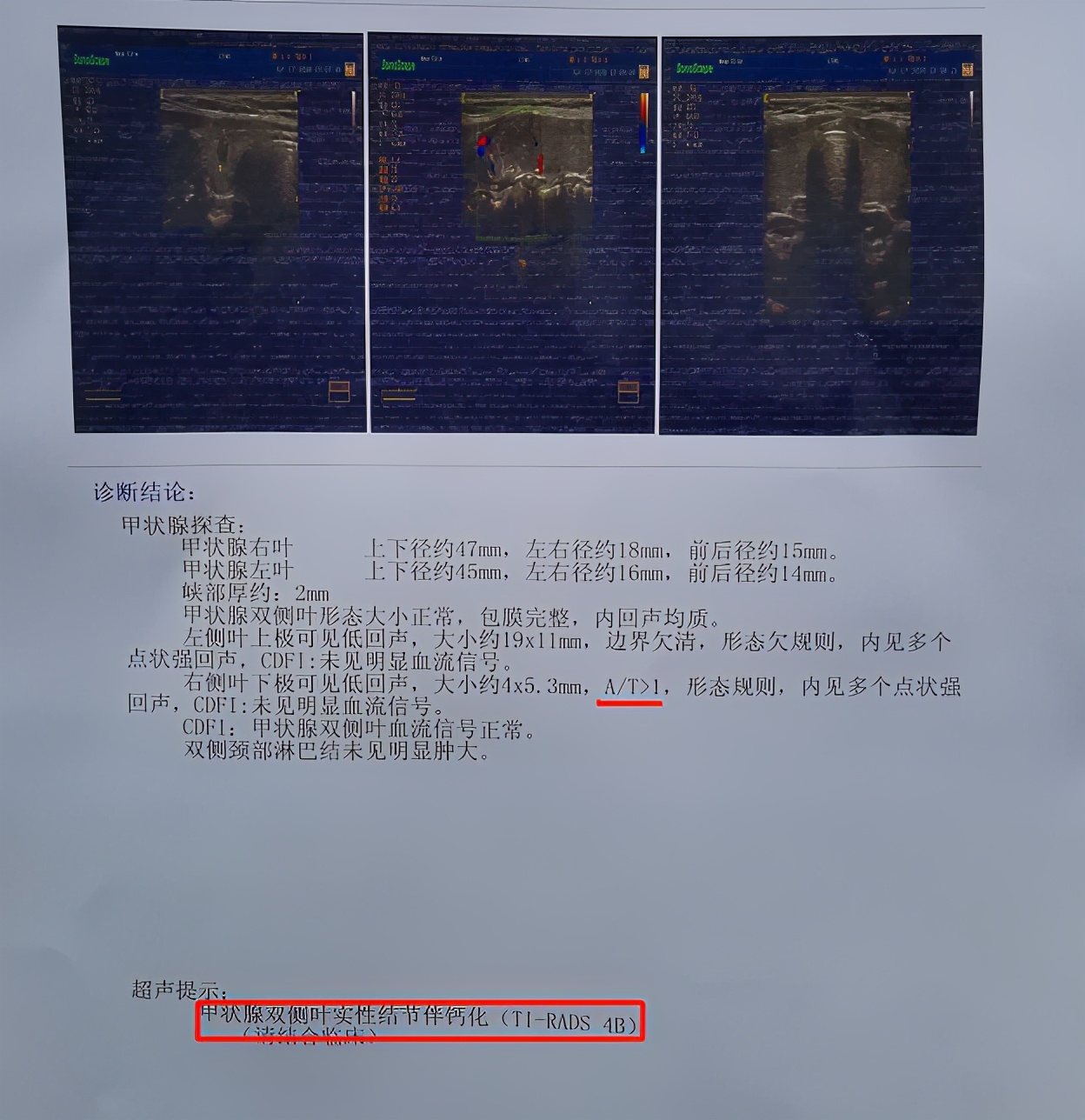 这结节没有任何征兆，突然就伴钙化了，妈妈总担心是癌怎么办？