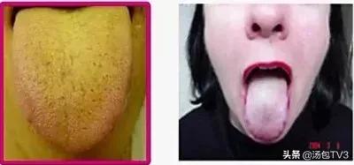 秋来湿未去！有这几个症状的人，你湿气太重了！快学一招排湿毒