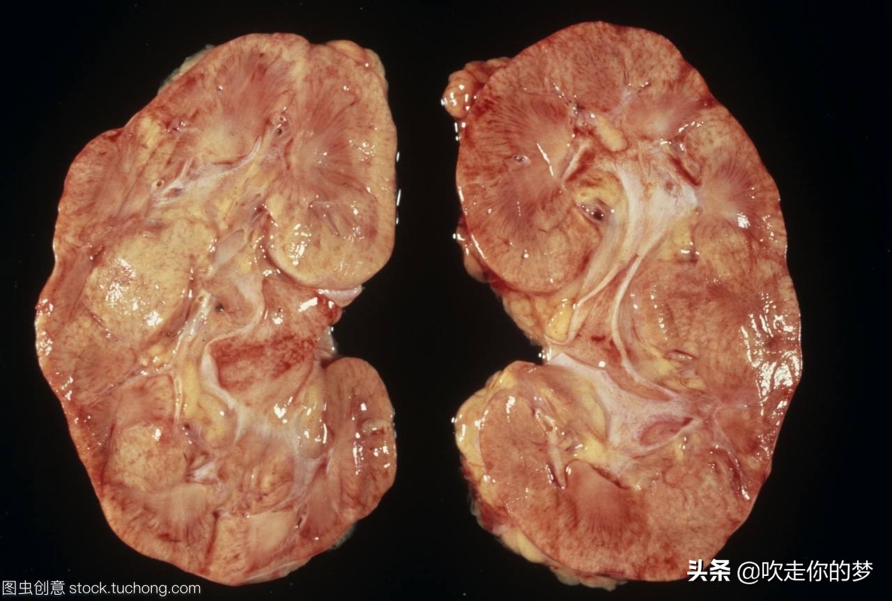 肾功能衰竭和肾衰竭一样不,肾衰竭跟肾功能衰竭一样吗