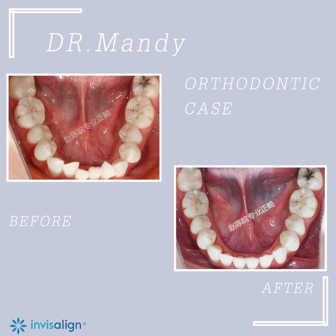 厦门牙齿矫正前后对比,牙齿矫正对脸型的改变有多大知乎