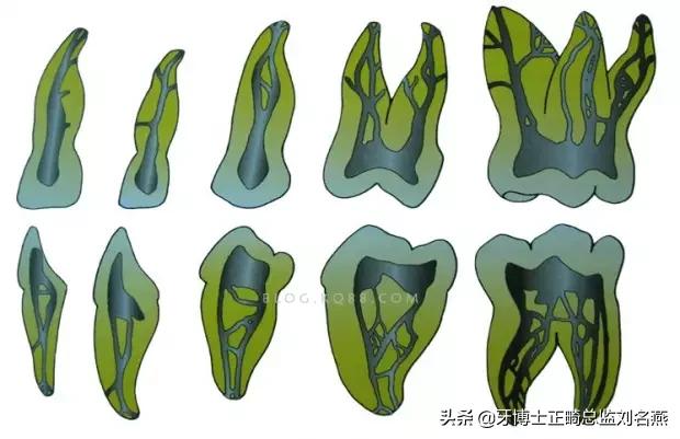 根管治疗难点与解决方案,根管治疗牢固吗