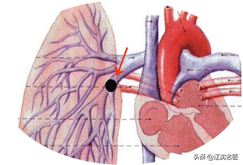 一条腿上血栓可怕吗,有一种血栓治不好