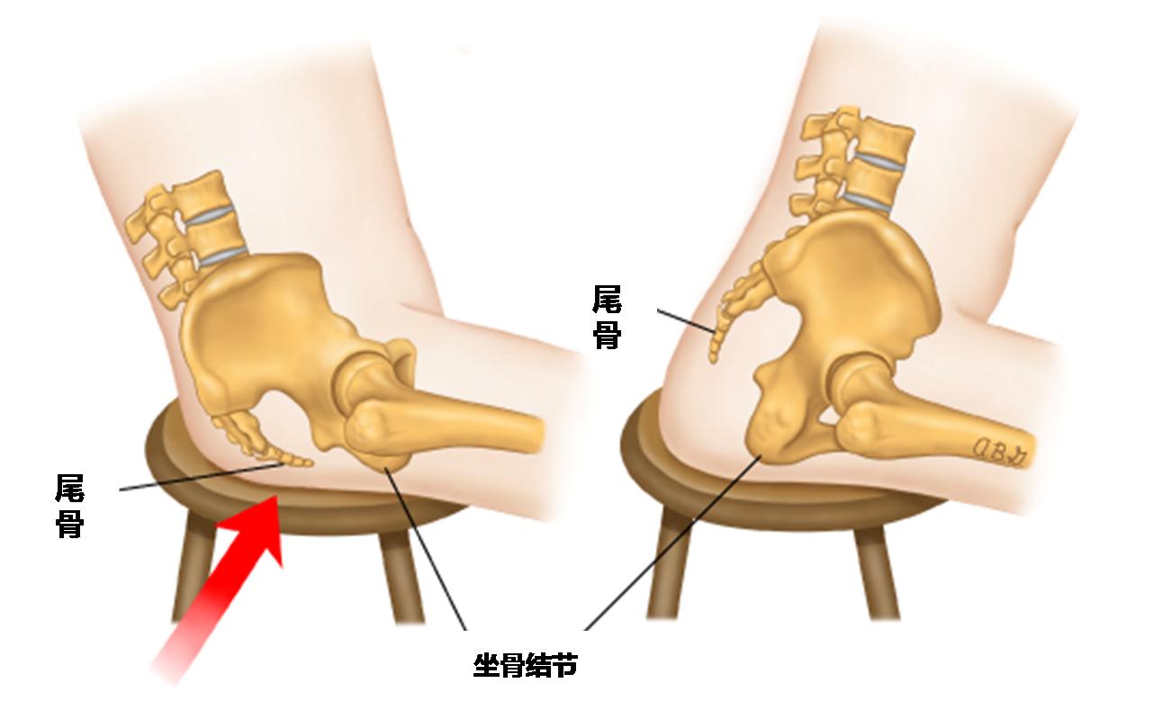 路桂军会阴疼痛治疗,尾骨受伤疼痛一招搞定