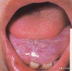 最实用的舌诊图六大舌象,舌诊深入学习书