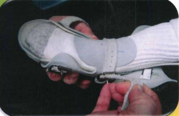 矫正鞋做法,马蹄足矫正鞋可调节